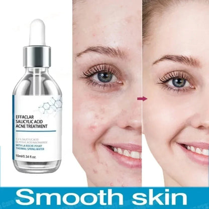 Face Serum Fruit Acid Acne Treatment Oil Control Remove Blackheads Shrink Pores Skin Texture Improve Care